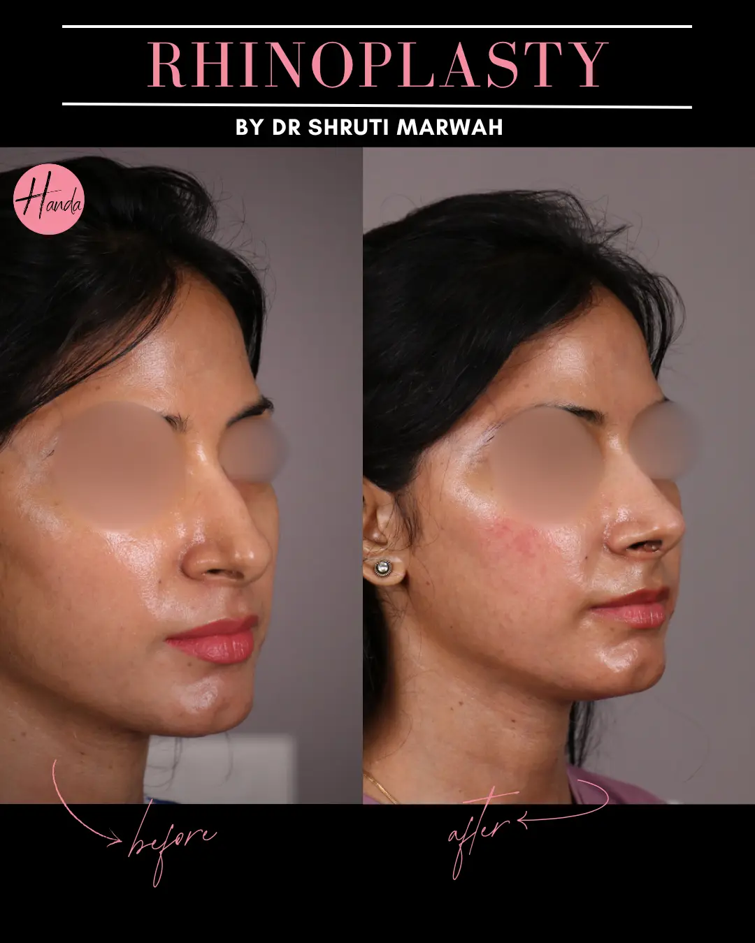 RHINOPLASTY before and after — Handa Aesthetics