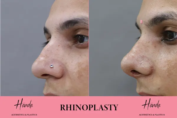 RHINOPLASTY before and after — Handa Aesthetics