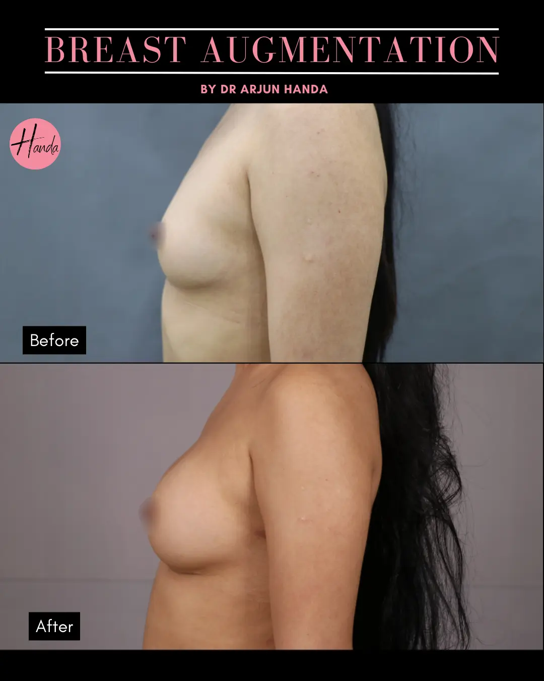 BREAST AUGMENTATION before and after — Handa Aesthetics