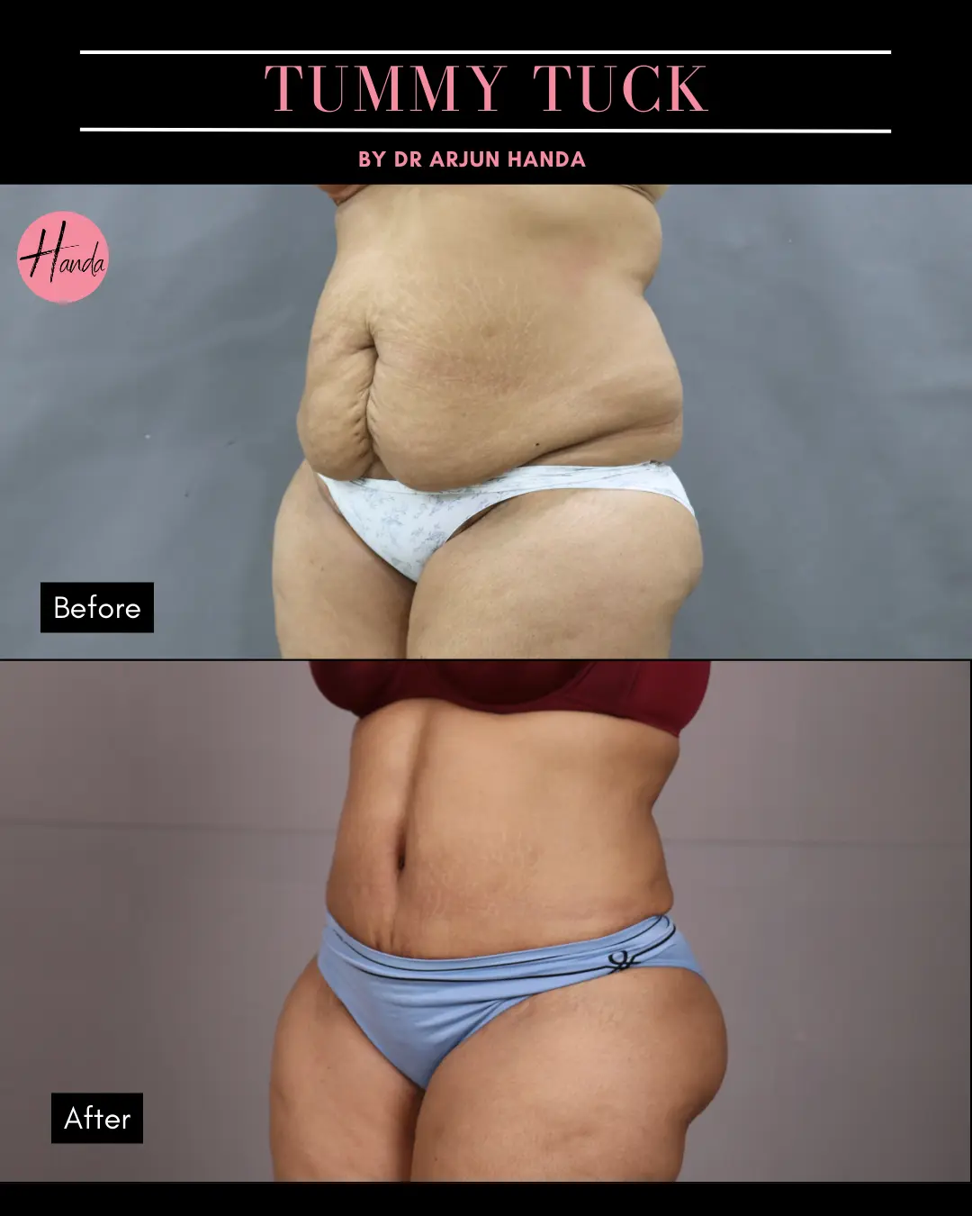 Tummy Tuck (Full Abdominoplasty) before and after — Handa Aesthetics