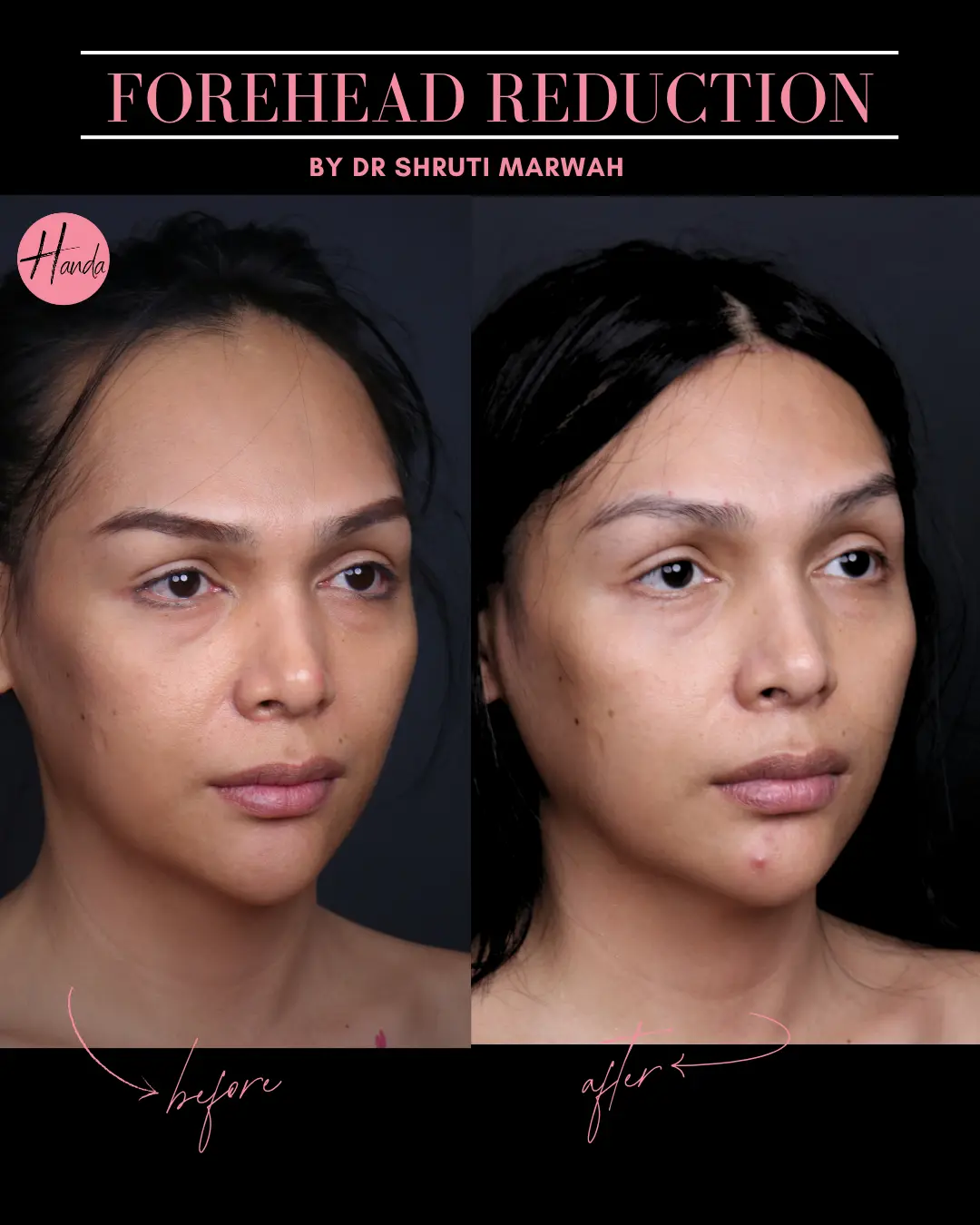 FOREHEAD REDUCTION before and after — Handa Aesthetics