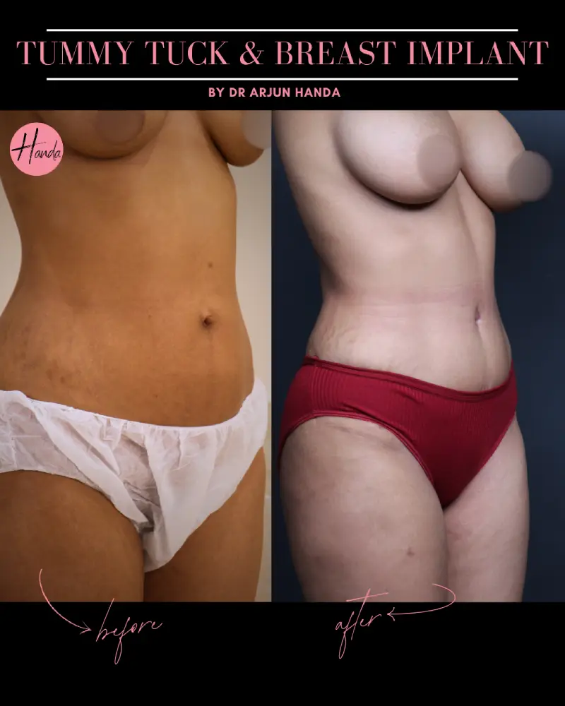 BREAST IMPLANT before and after — Handa Aesthetics