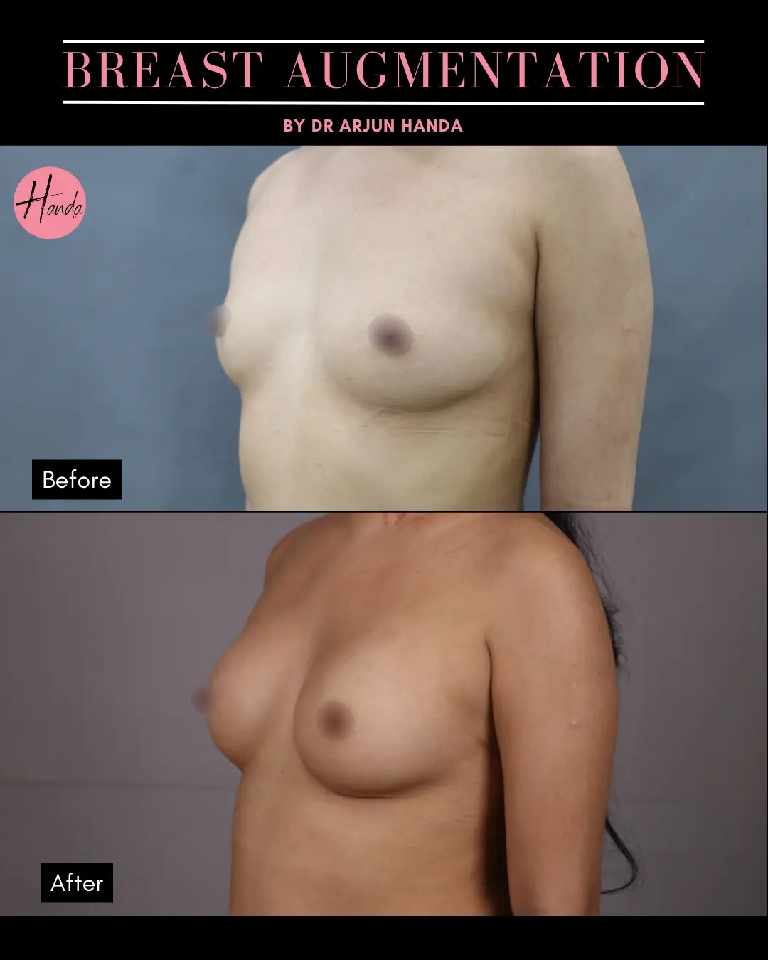 BREAST AUGMENTATION before and after — Handa Aesthetics