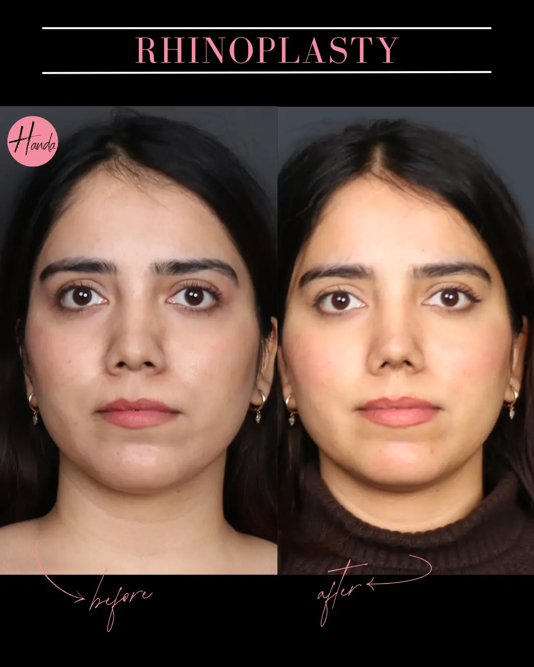 RHINOPLASTY before and after — Handa Aesthetics