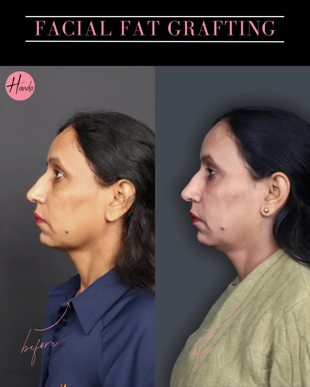 FACIAL FAT GRAFTING before and after — Handa Aesthetics