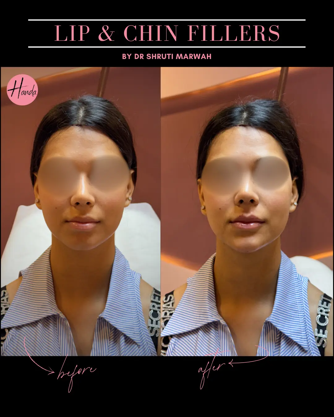 CHIN & LIP FILLERS before and after — Handa Aesthetics