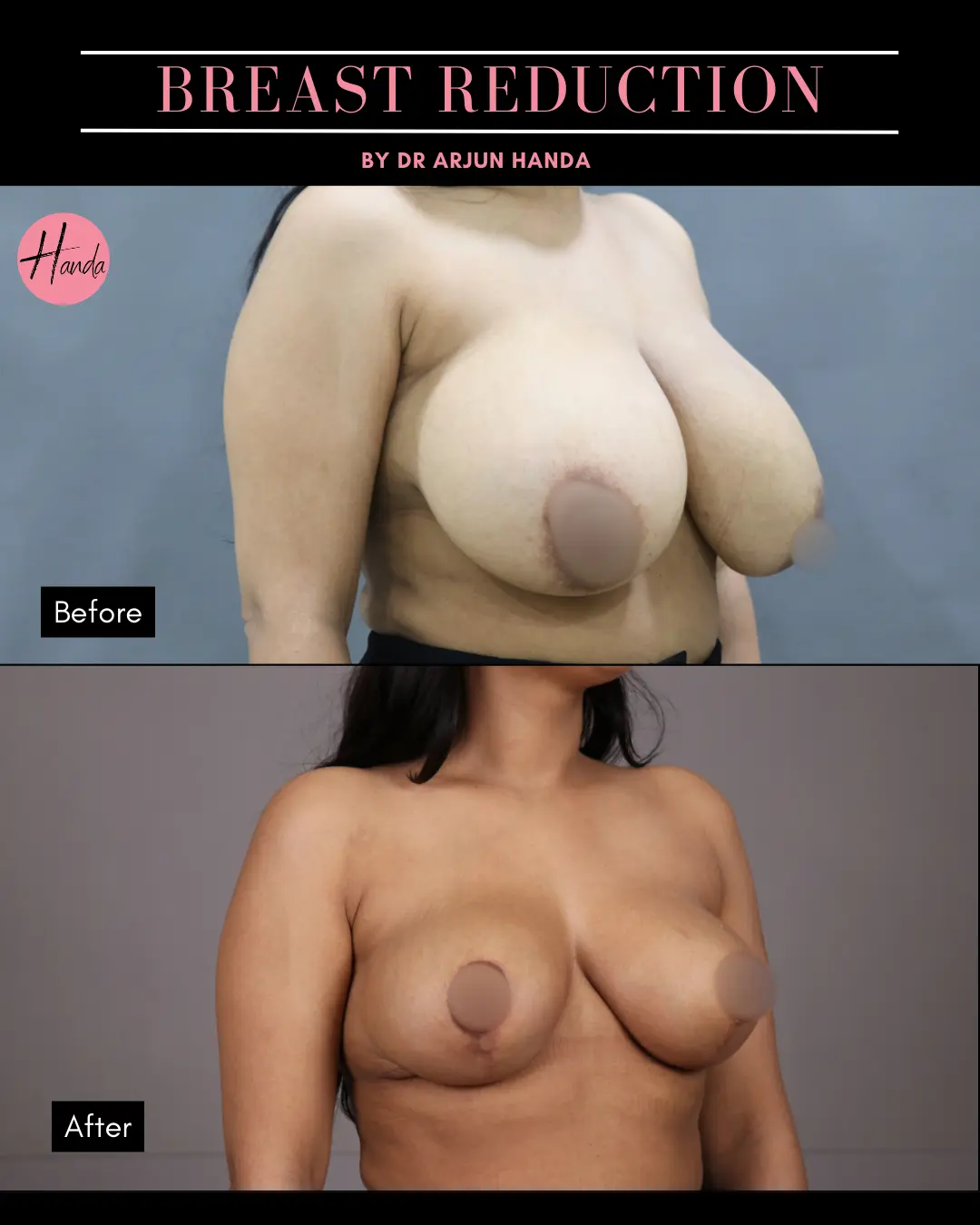 BREAST REDUCTION AND LIFT before and after — Handa Aesthetics