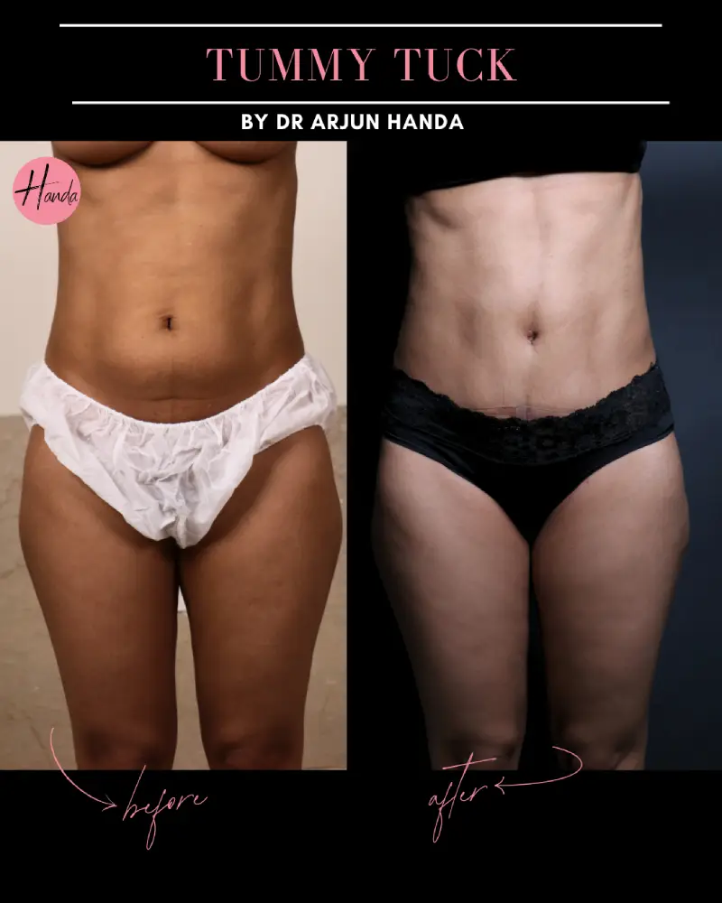 Tummy Tuck (Full Abdominoplasty) before and after — Handa Aesthetics