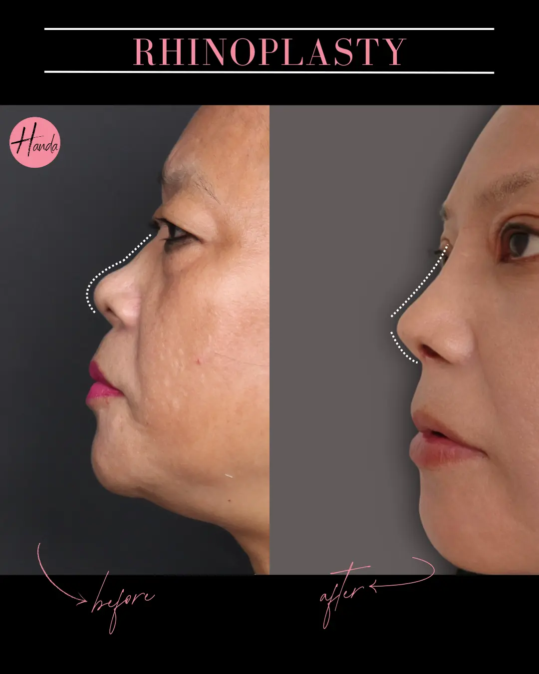 RHINOPLASTY before and after — Handa Aesthetics