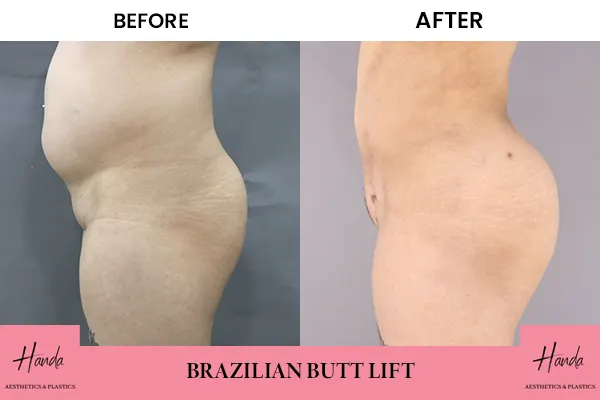 Butt Lift before and after — Handa Aesthetics
