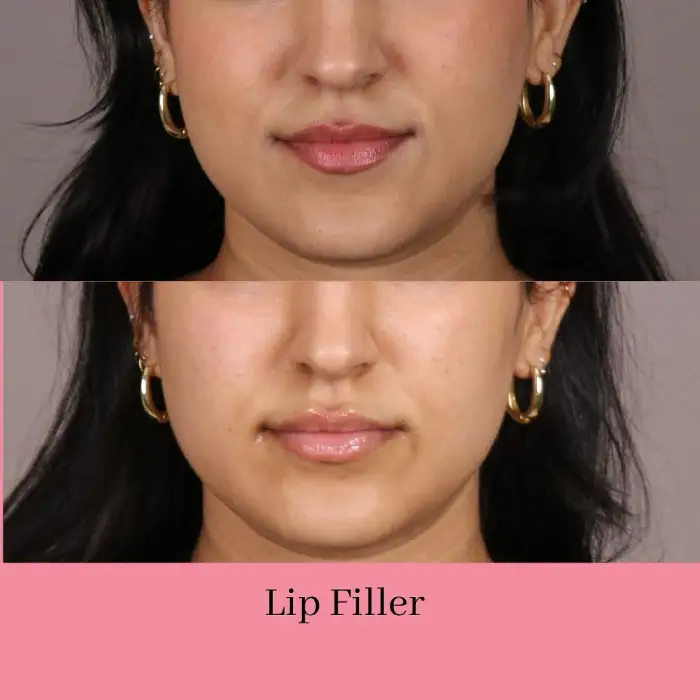 Body Contouring before and after — Handa Aesthetics