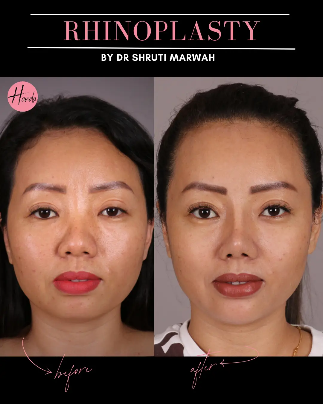 RHINOPLASTY before and after — Handa Aesthetics