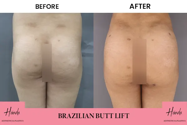 Butt Lift before and after — Handa Aesthetics