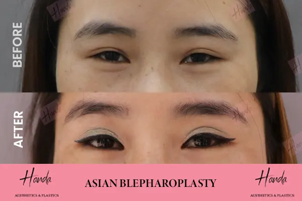 ASIAN BLEPHAROPLASTY before and after — Handa Aesthetics