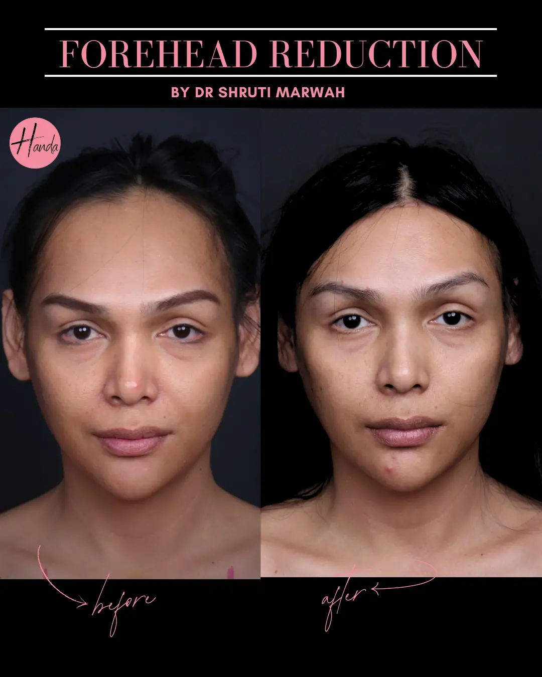 FOREHEAD REDUCTION before and after — Handa Aesthetics