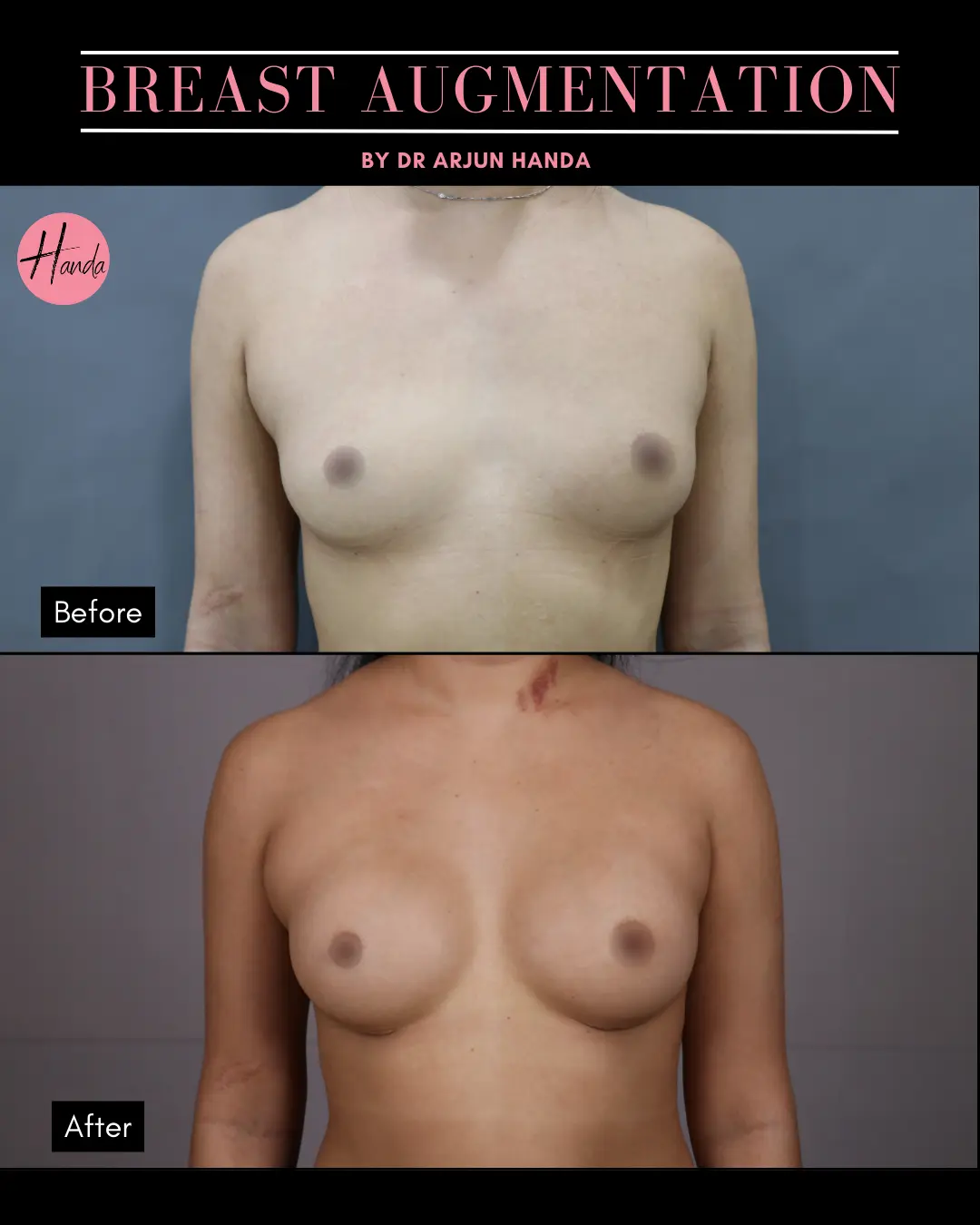 BREAST AUGMENTATION before and after — Handa Aesthetics