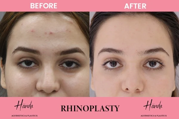 RHINOPLASTY before and after — Handa Aesthetics