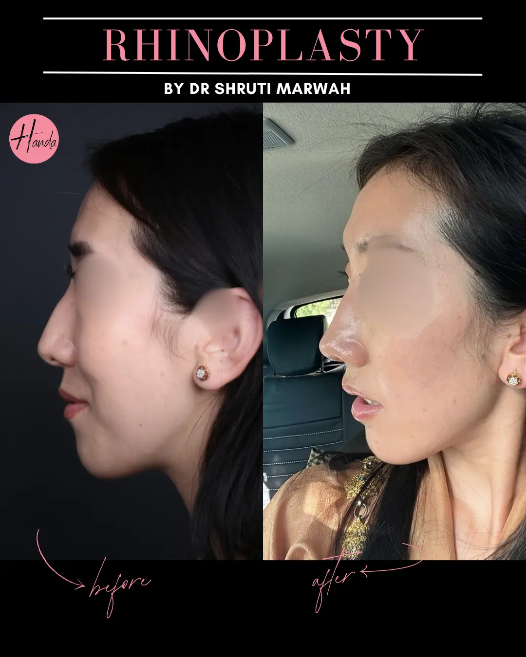 RHINOPLASTY before and after — Handa Aesthetics