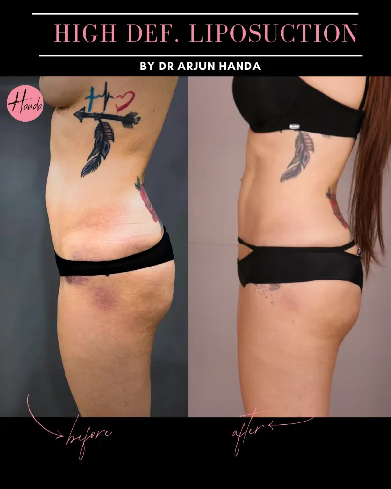Liposuction before and after — Handa Aesthetics