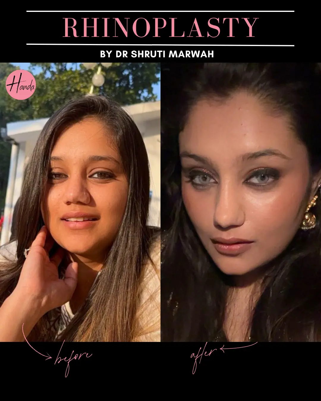 RHINOPLASTY before and after — Handa Aesthetics