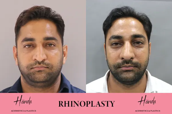 RHINOPLASTY before and after — Handa Aesthetics