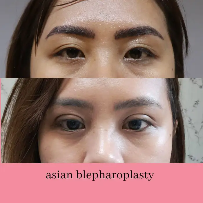 ASIAN BLEPHAROPLASTY before and after — Handa Aesthetics