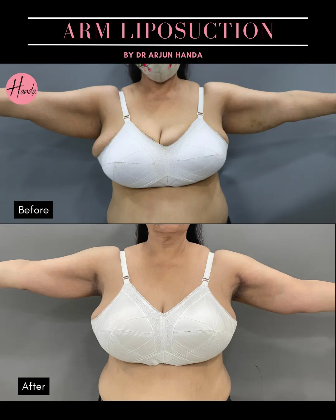 Arms & Thighs Lift before and after — Handa Aesthetics