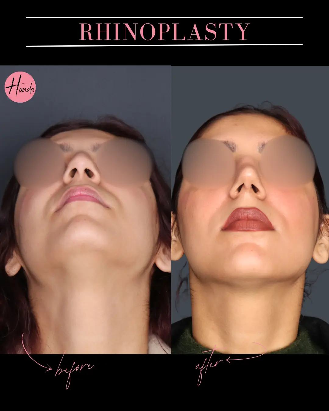 RHINOPLASTY before and after — Handa Aesthetics