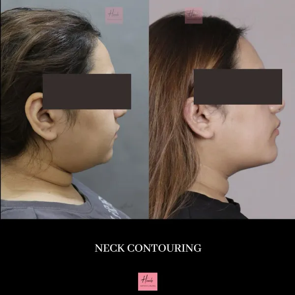 Face before and after — Handa Aesthetics