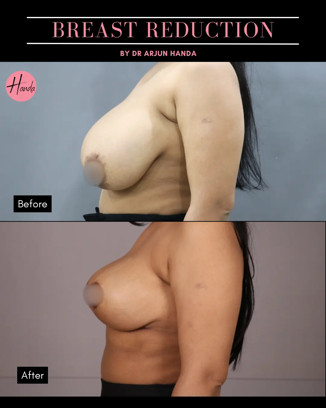 BREAST REDUCTION AND LIFT before and after — Handa Aesthetics