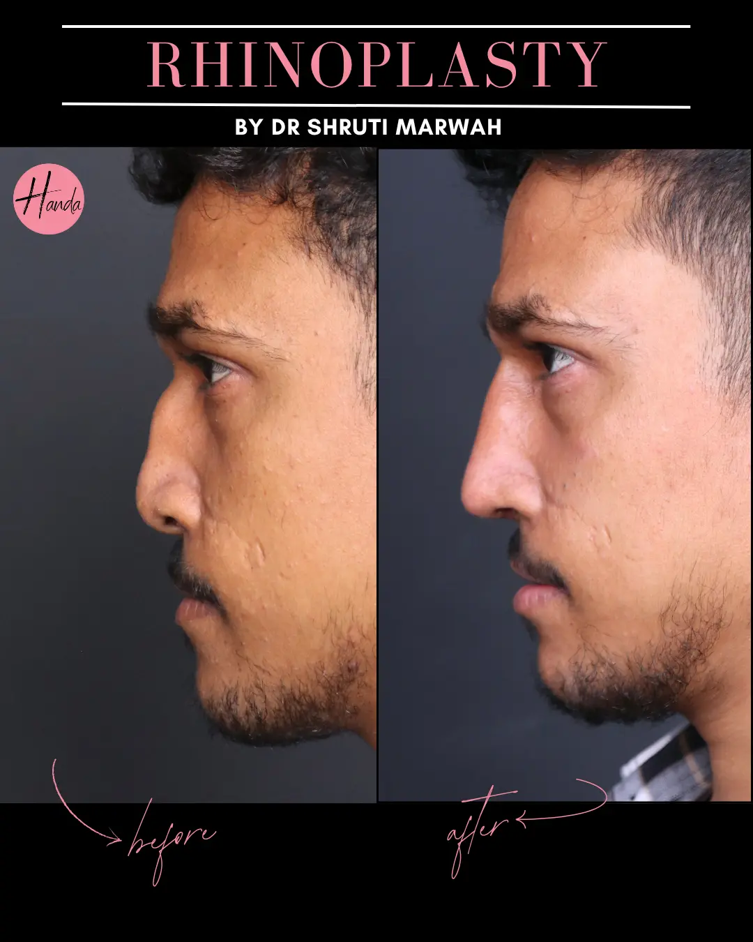 RHINOPLASTY before and after — Handa Aesthetics