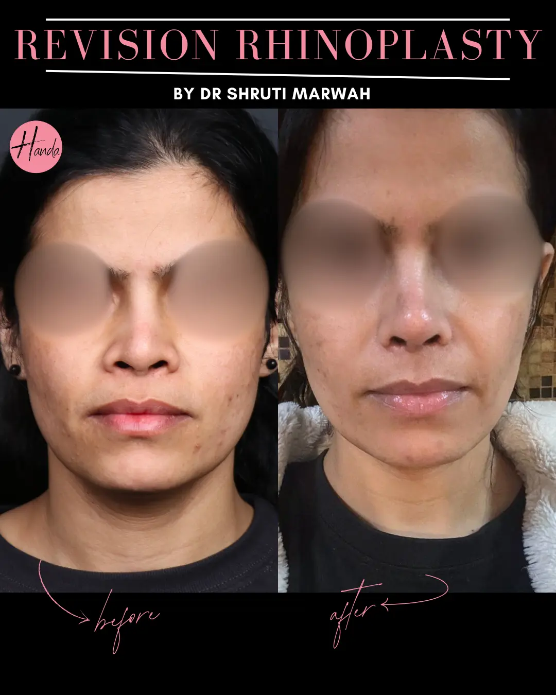 RHINOPLASTY before and after — Handa Aesthetics