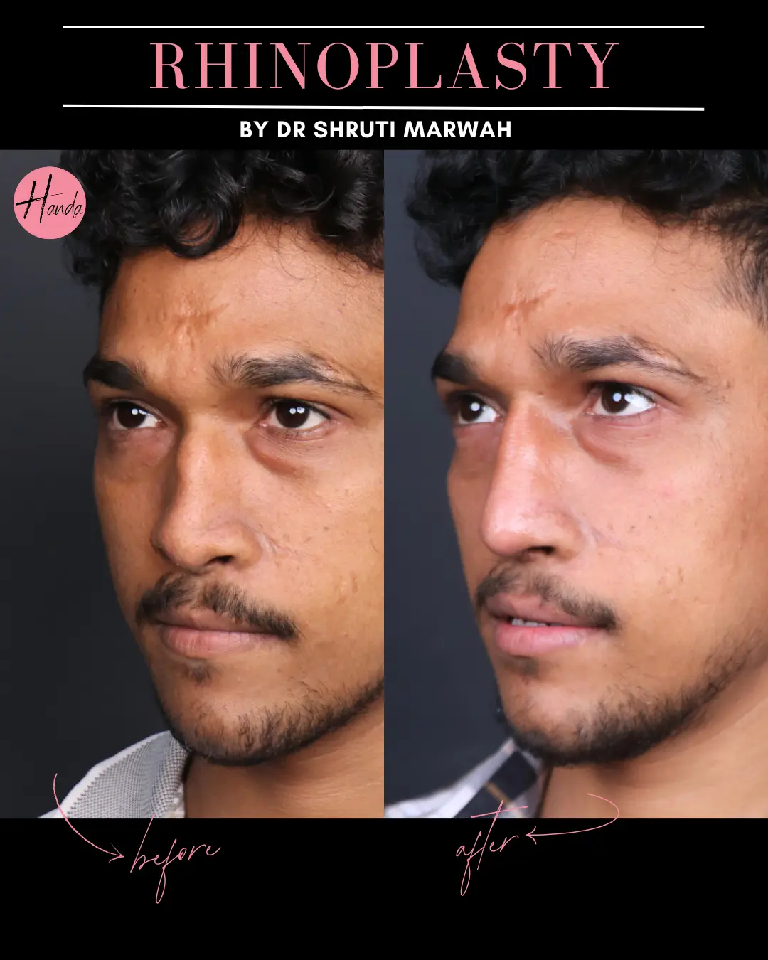 RHINOPLASTY before and after — Handa Aesthetics