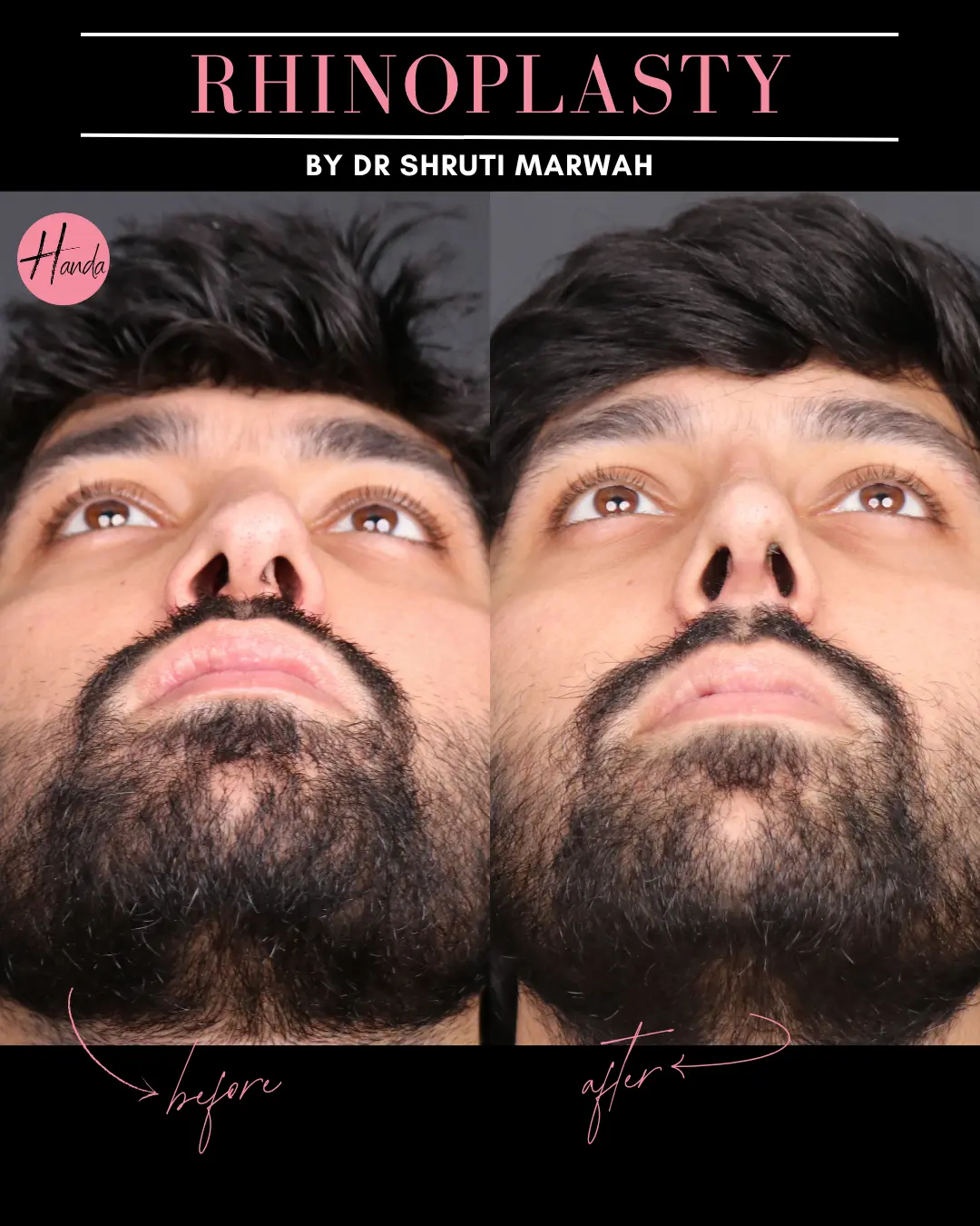 RHINOPLASTY before and after — Handa Aesthetics