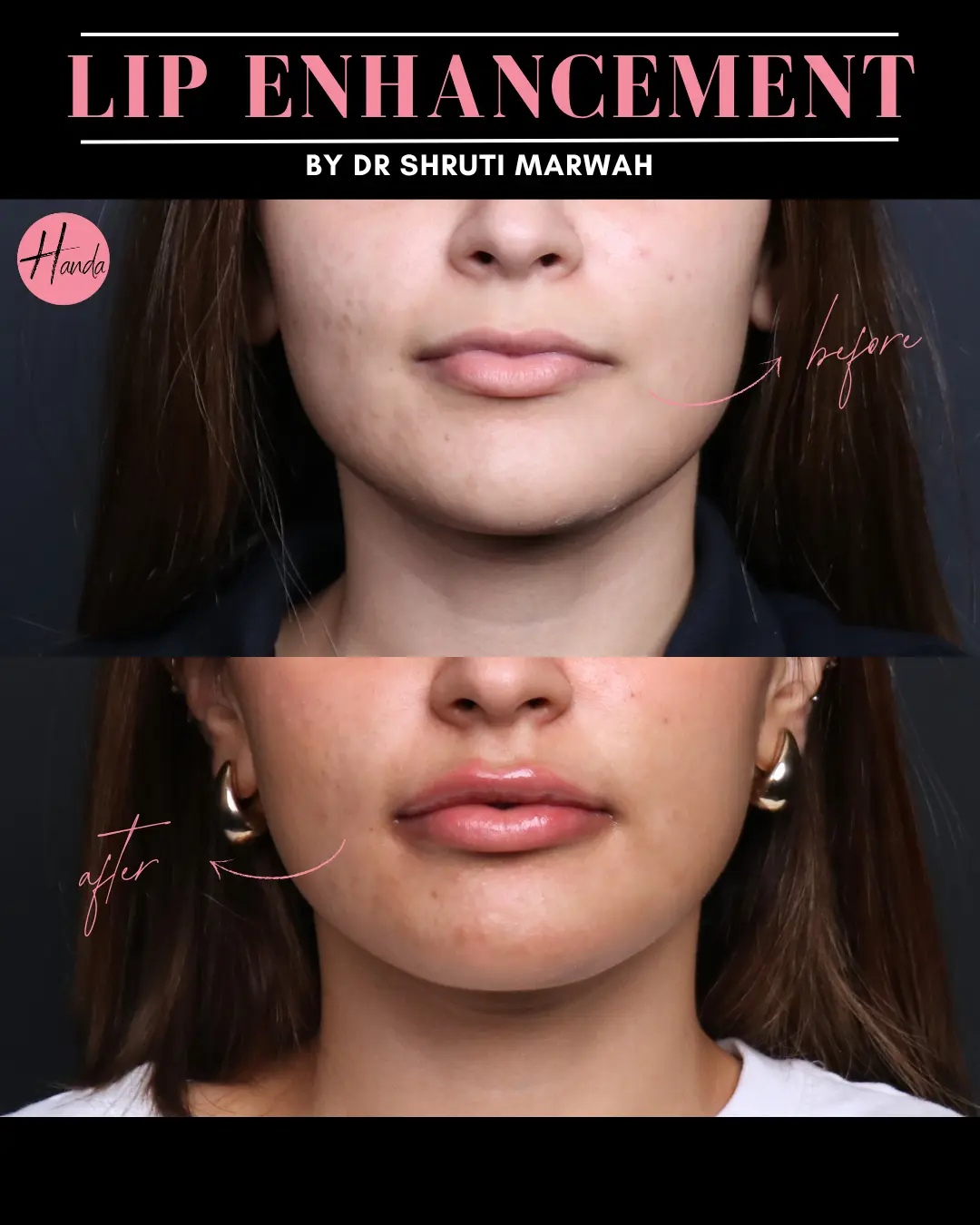 Body Contouring before and after — Handa Aesthetics