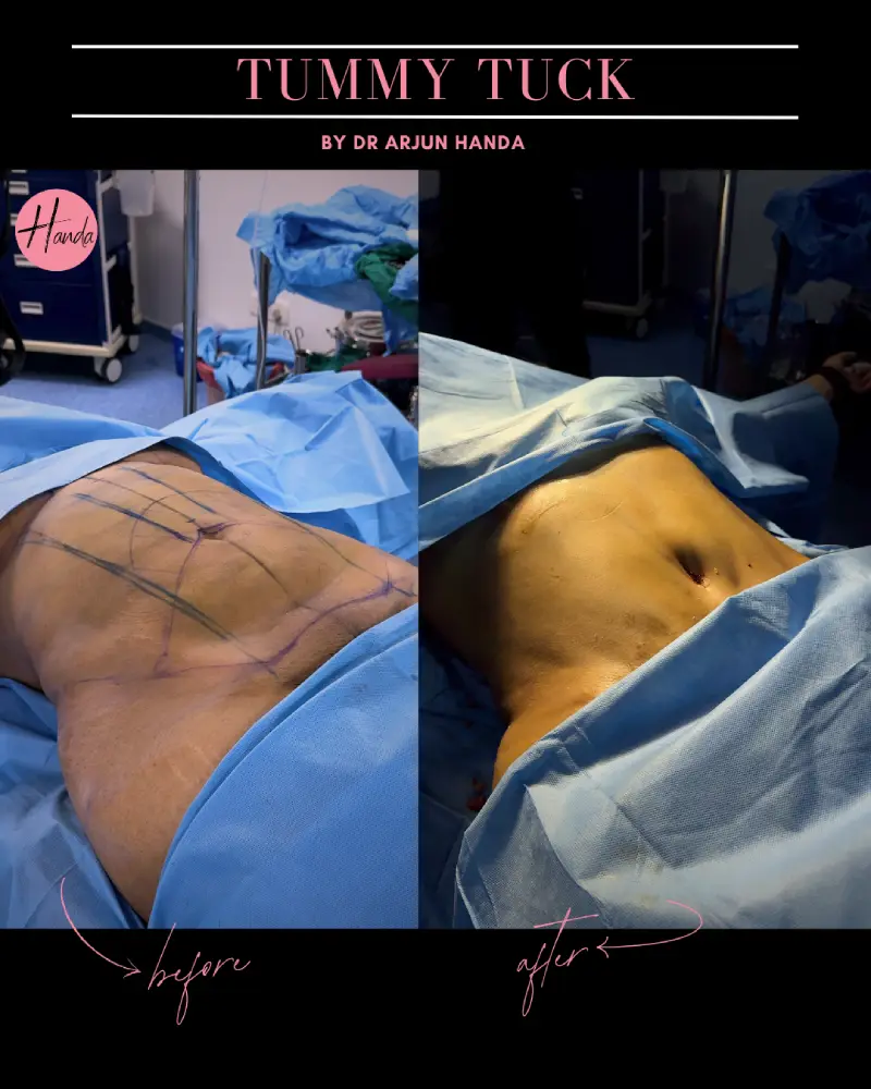 Tummy Tuck (Full Abdominoplasty) before and after — Handa Aesthetics
