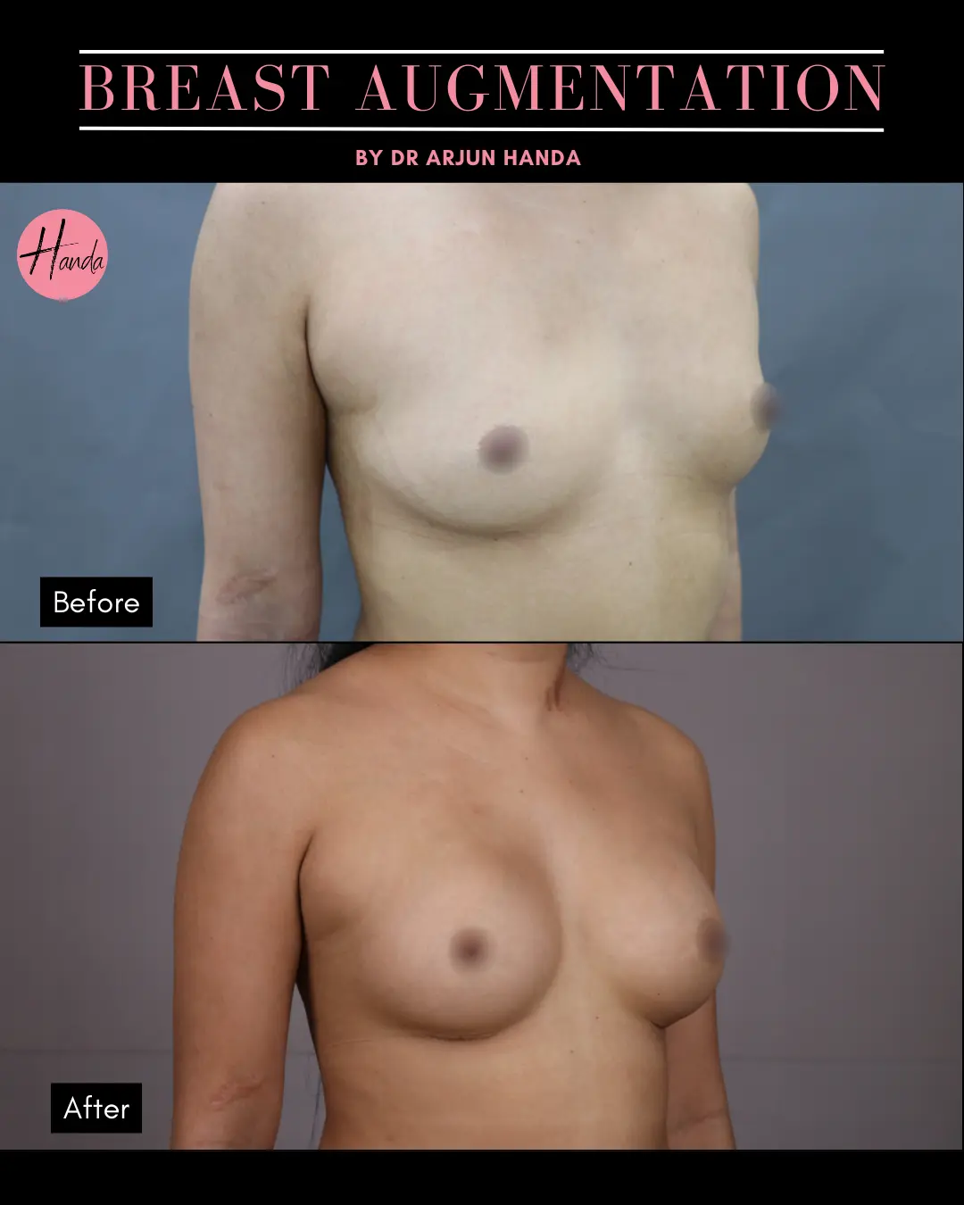 BREAST AUGMENTATION before and after — Handa Aesthetics