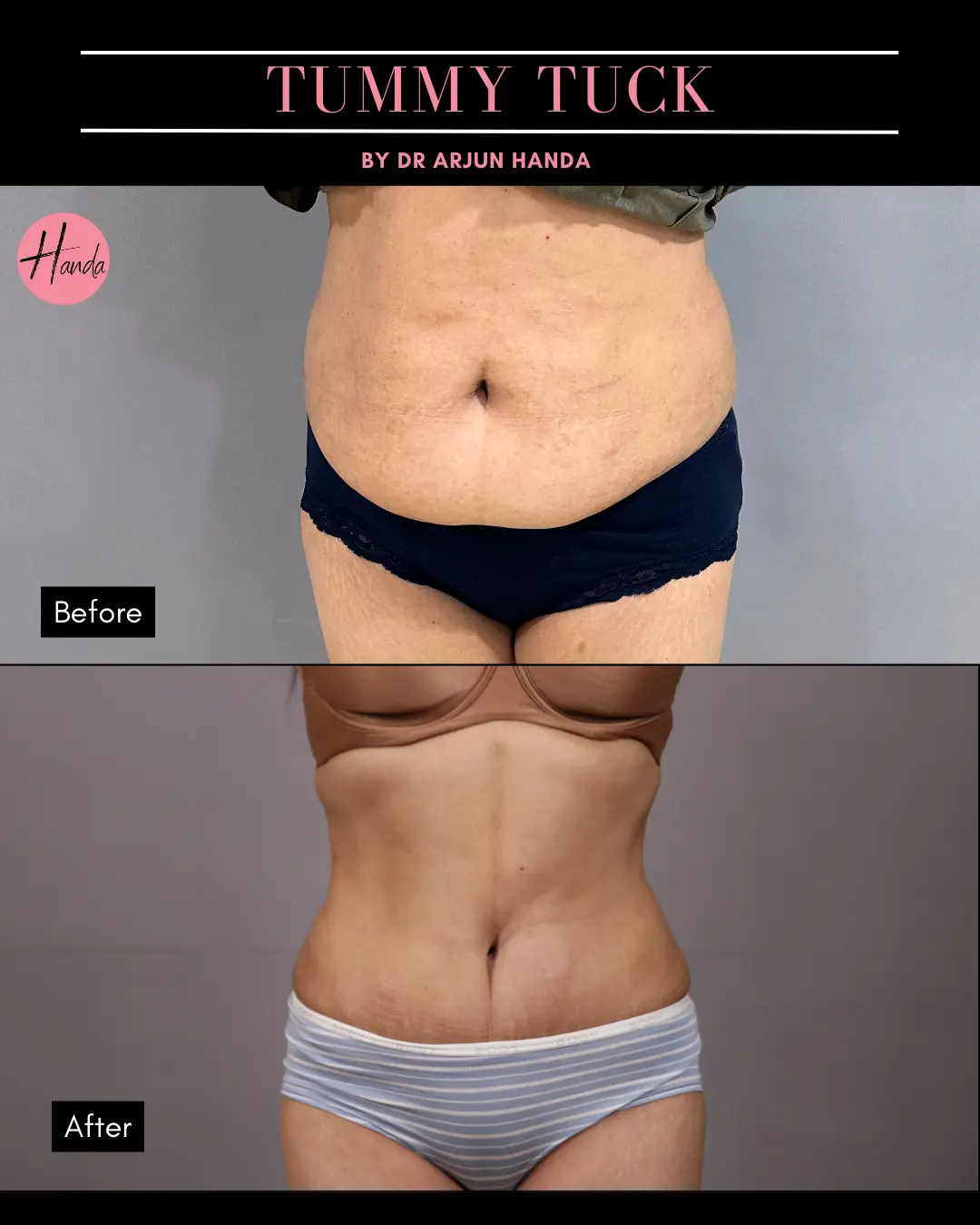 Tummy Tuck (Full Abdominoplasty) before and after — Handa Aesthetics