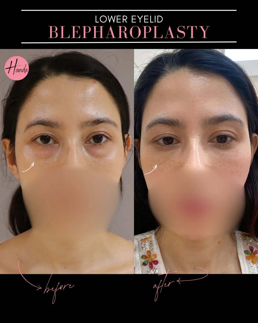 ASIAN BLEPHAROPLASTY before and after — Handa Aesthetics
