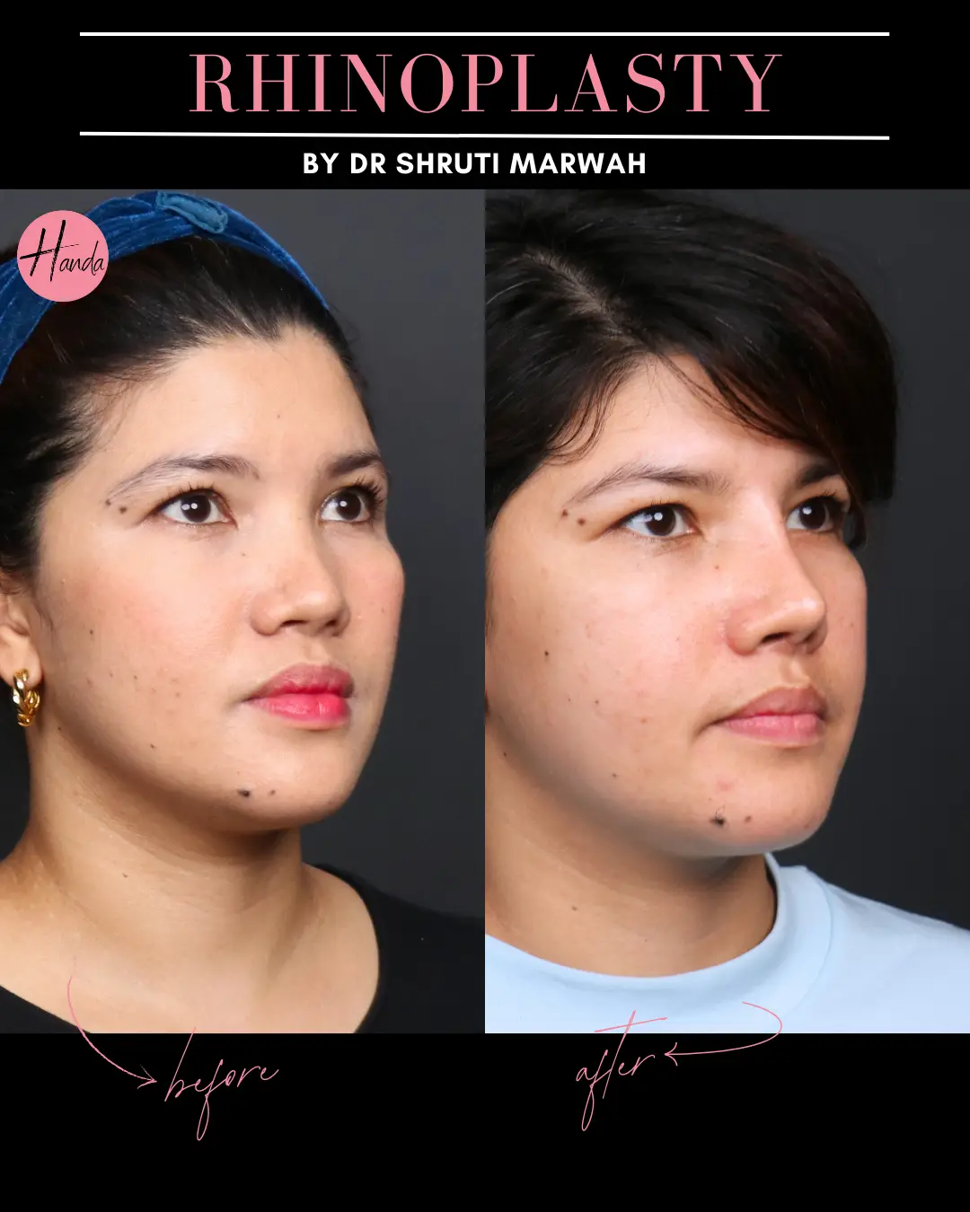 RHINOPLASTY before and after — Handa Aesthetics