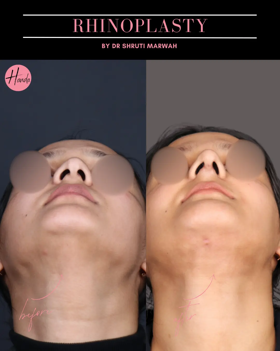 RHINOPLASTY before and after — Handa Aesthetics