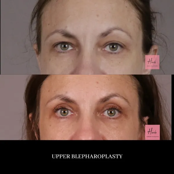 Face before and after — Handa Aesthetics