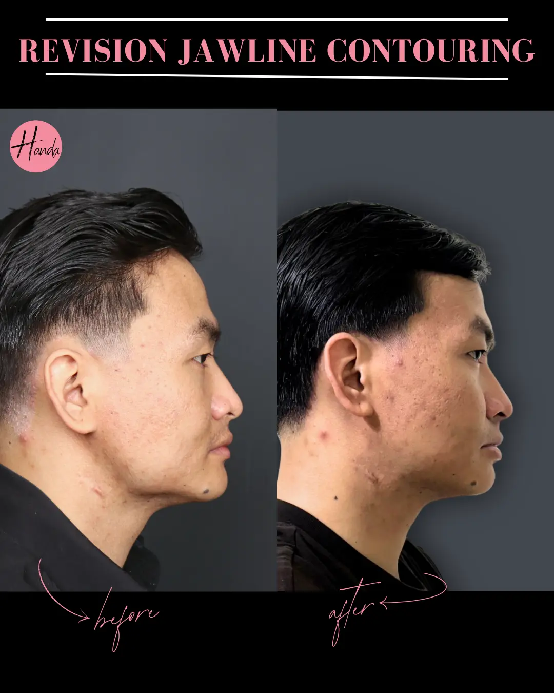 CHIN & JAWLINE LIPOSUCTION before and after — Handa Aesthetics