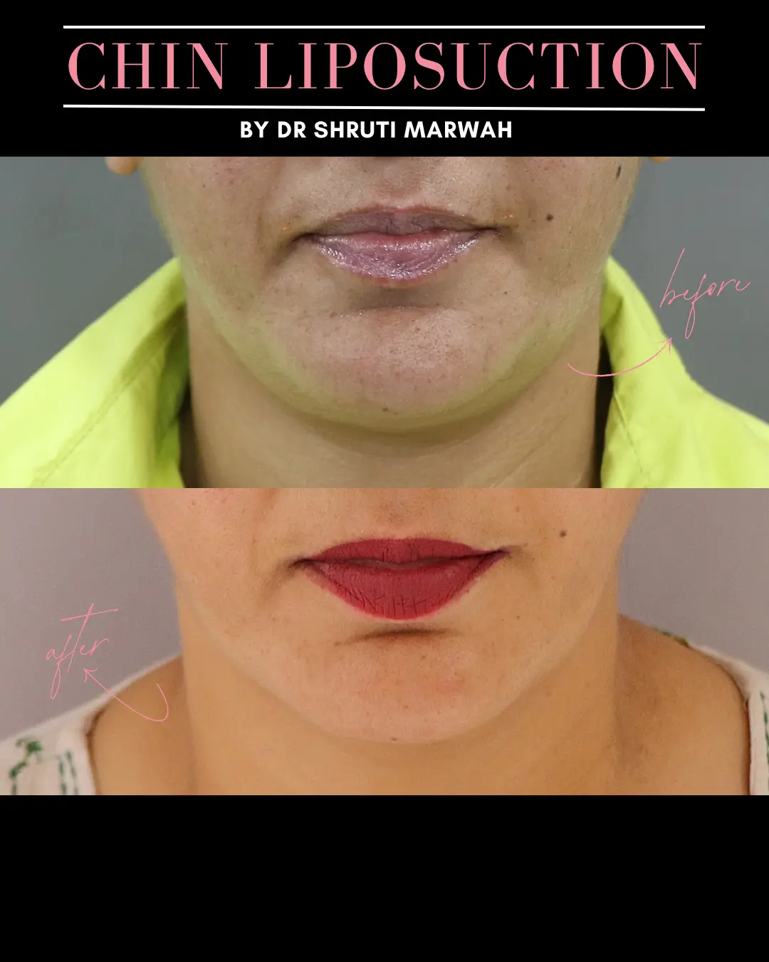 CHIN & JAWLINE LIPOSUCTION before and after — Handa Aesthetics