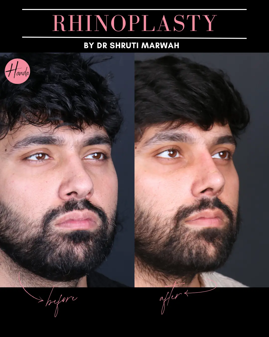 RHINOPLASTY before and after — Handa Aesthetics