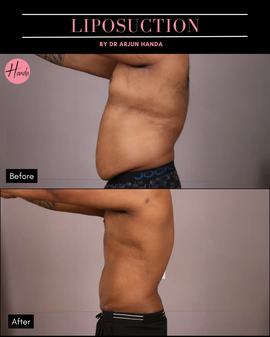 Liposuction before and after — Handa Aesthetics