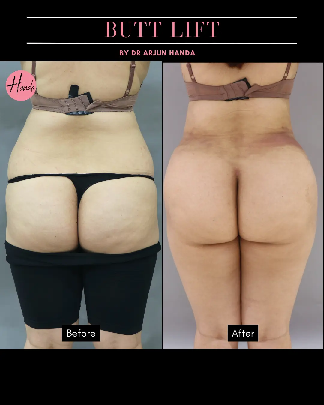 Butt Lift before and after — Handa Aesthetics