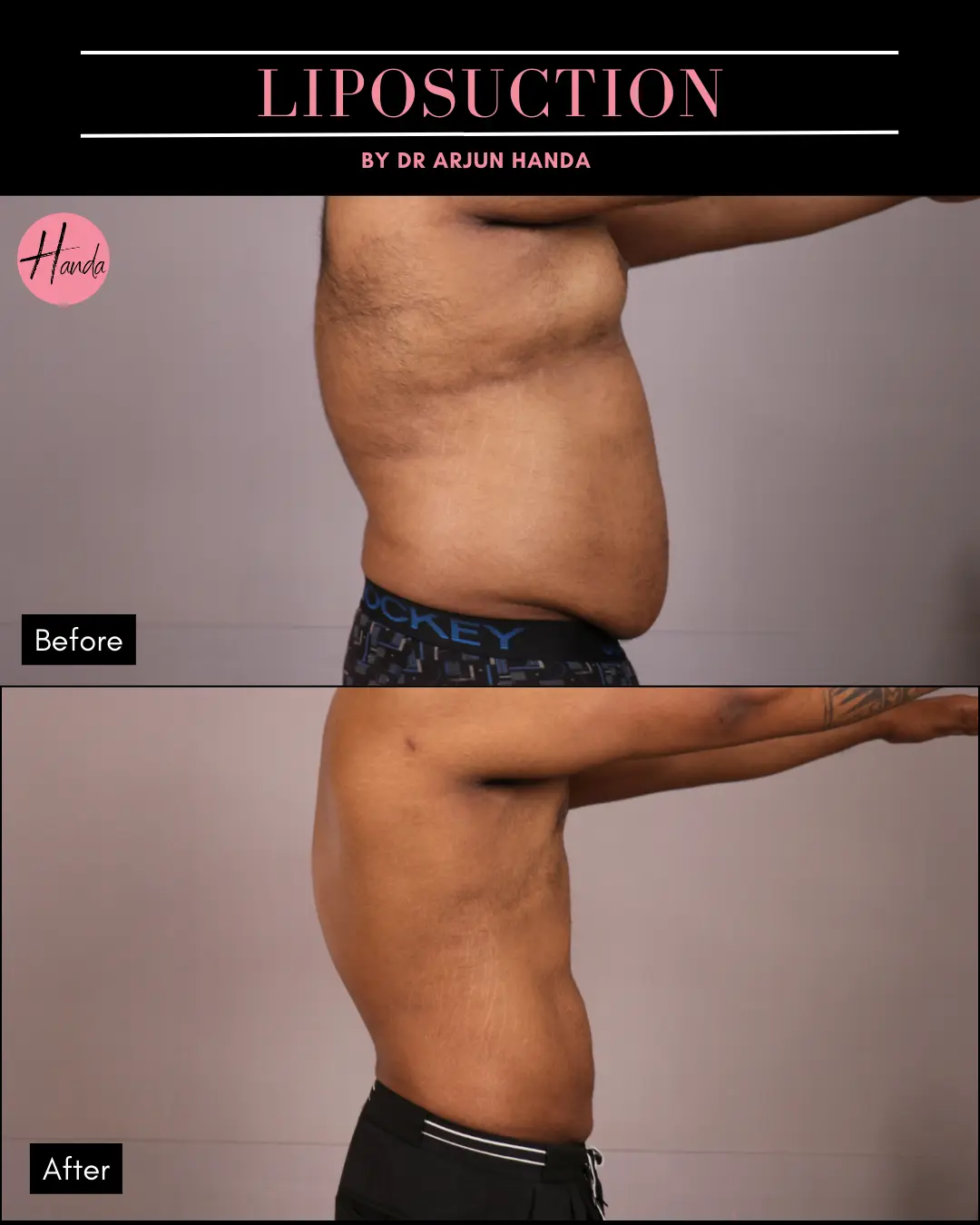 Liposuction before and after — Handa Aesthetics