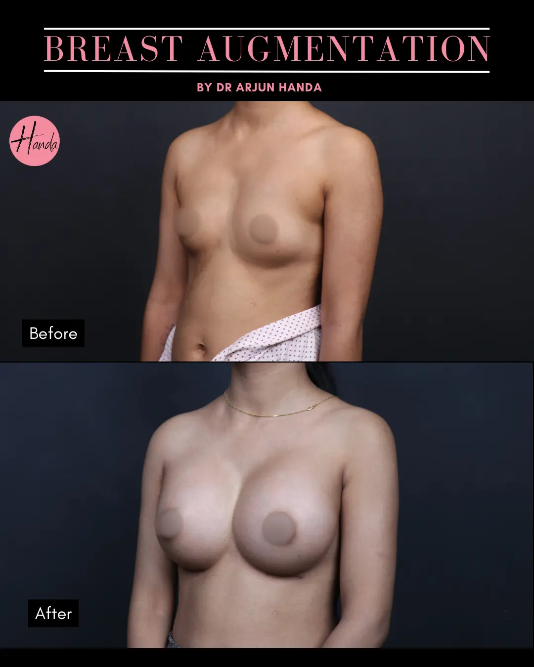 BREAST AUGMENTATION before and after — Handa Aesthetics