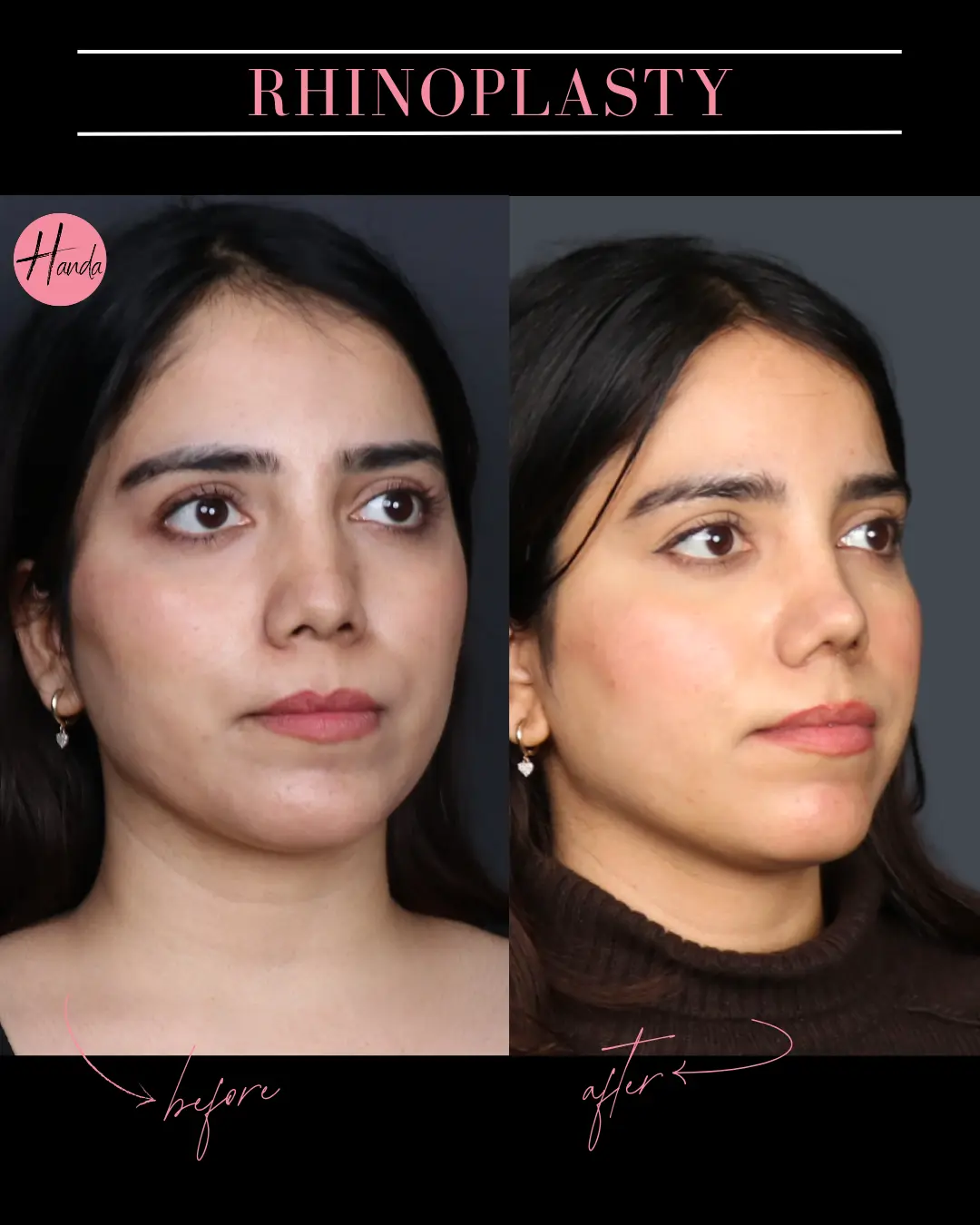 RHINOPLASTY before and after — Handa Aesthetics